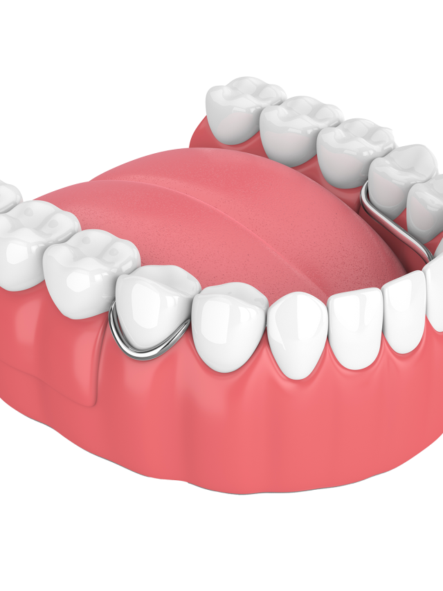Removable partial denture options