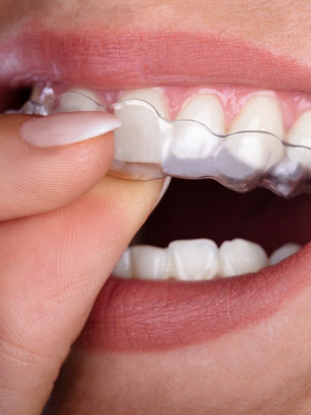 Advanced orthodontic care can treat: