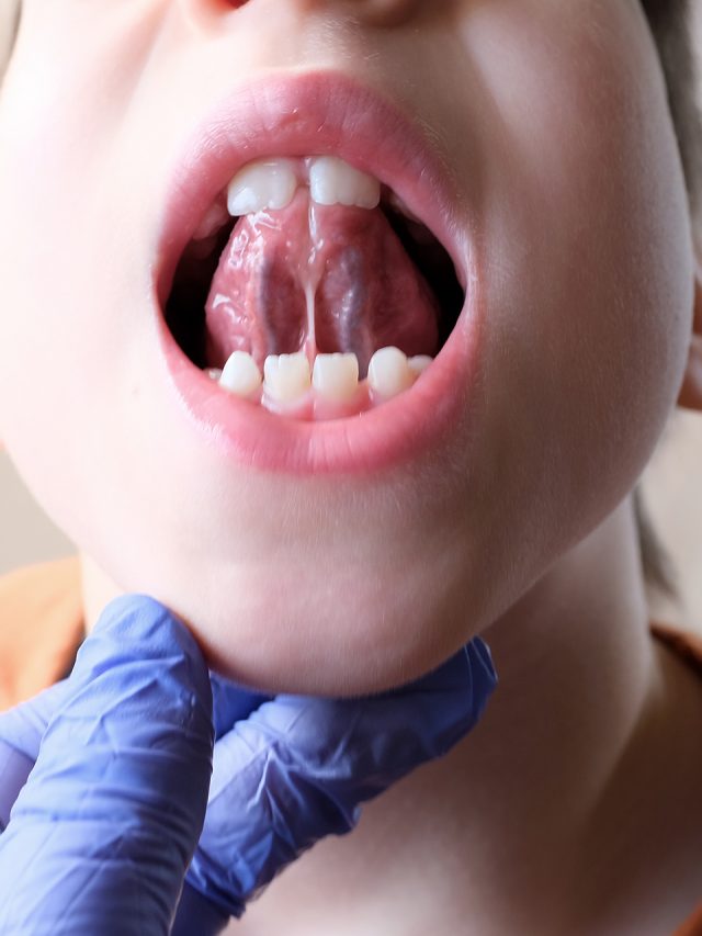 How can a frenectomy help treat tongue-tie?